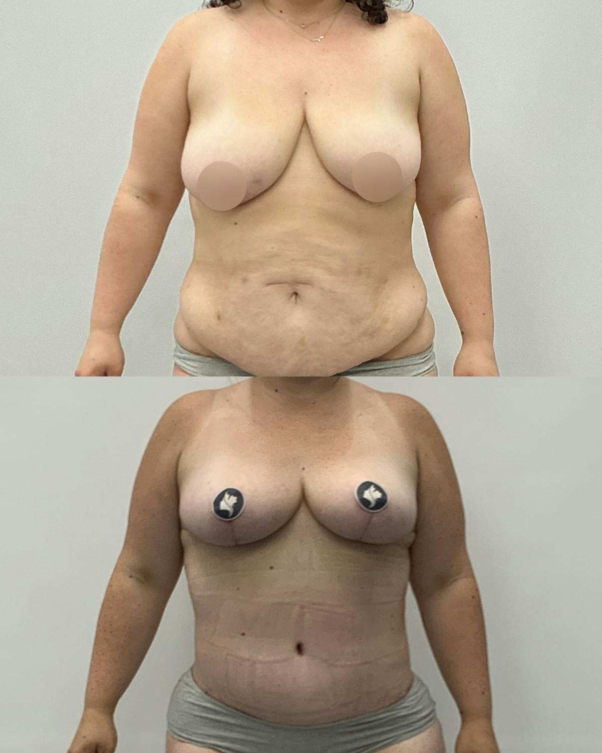 Mommy Makeover Before & After Gallery - Patient 642489 - Image 1