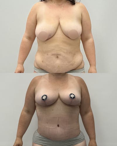 Mommy Makeover Before & After Gallery - Patient 642489 - Image 1