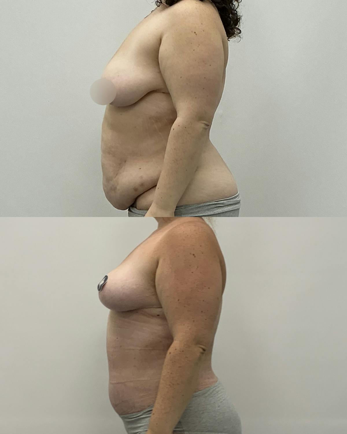 Mommy Makeover Before & After Gallery - Patient 642489 - Image 2