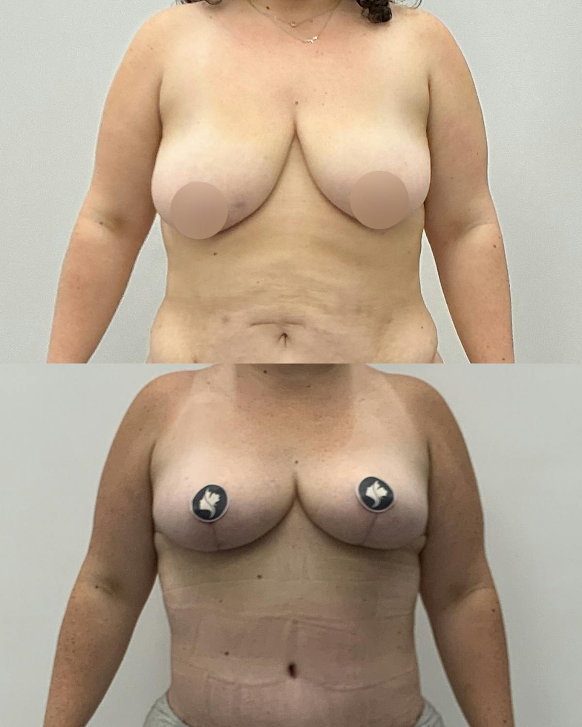 Breast Lift Before & After Gallery - Patient 303095 - Image 1