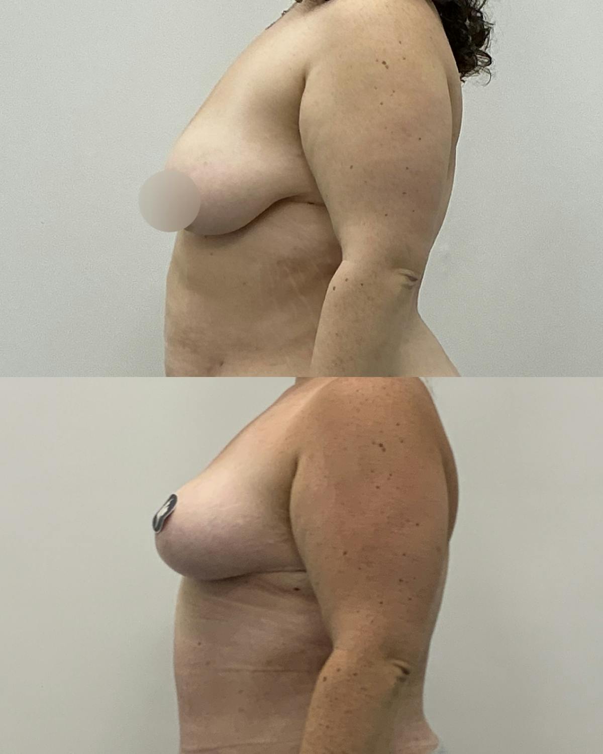 Breast Lift Before & After Gallery - Patient 303095 - Image 3