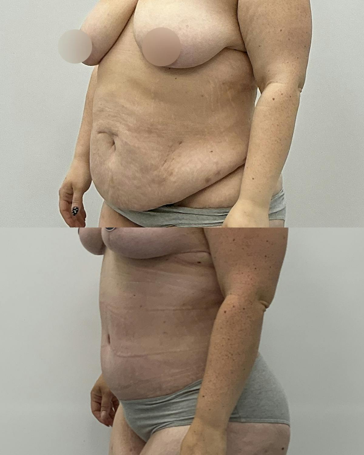 Tummy Tuck Before & After Gallery - Patient 461396 - Image 2
