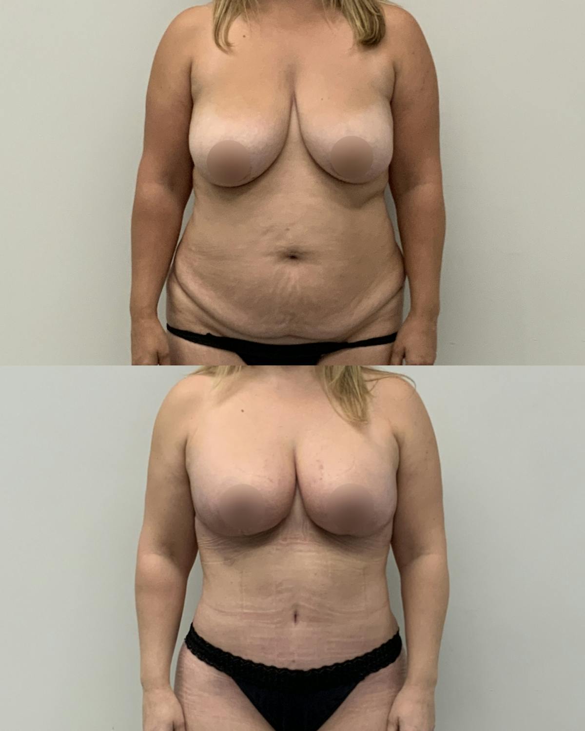 Mommy Makeover Before & After Gallery - Patient 269700 - Image 1