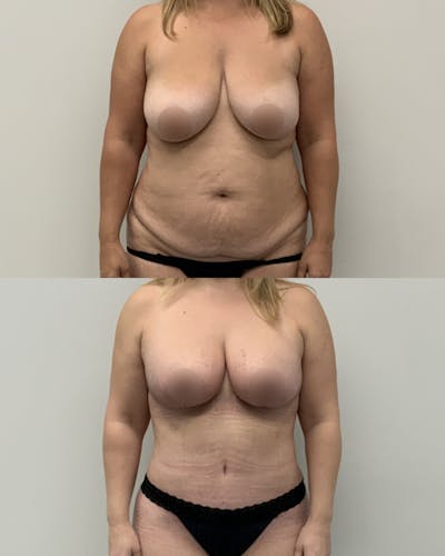 Mommy Makeover Before & After Gallery - Patient 269700 - Image 1