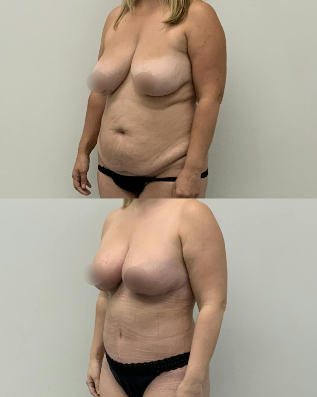 Mommy Makeover Before & After Gallery - Patient 269700 - Image 2