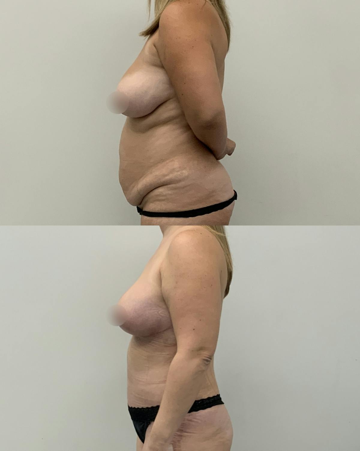 Mommy Makeover Before & After Gallery - Patient 269700 - Image 3