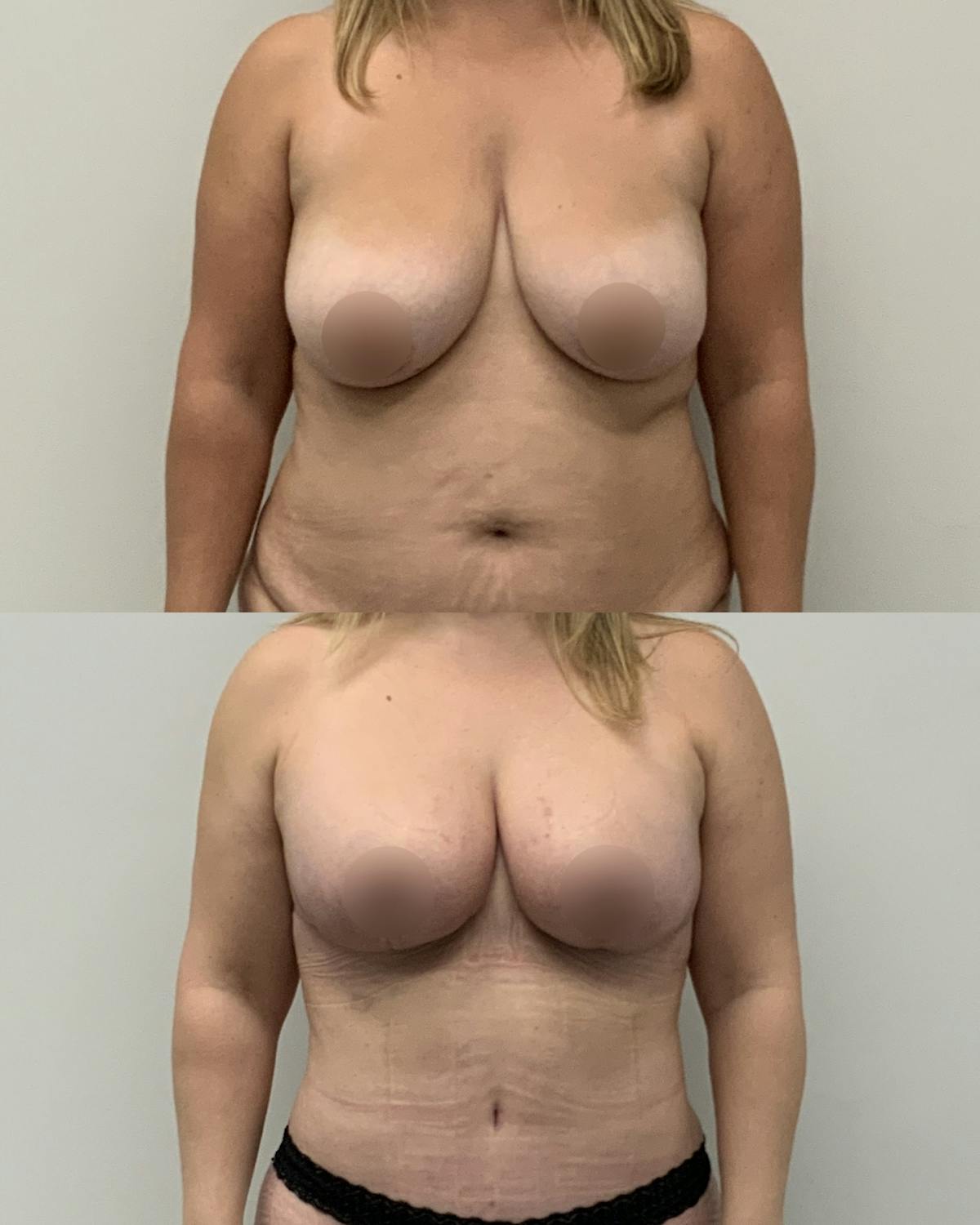 Breast Reduction Before & After Gallery - Patient 254977 - Image 1