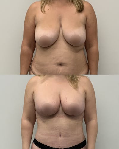 Breast Lift Before & After Gallery - Patient 497777 - Image 1
