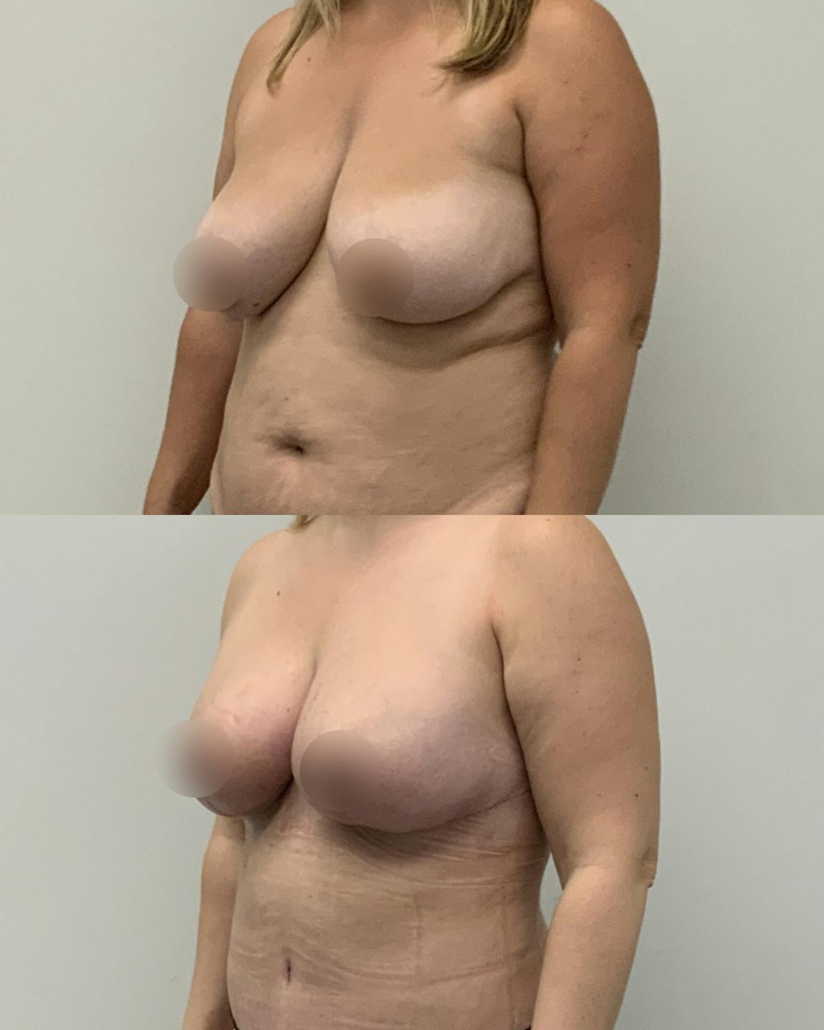Breast Reduction Before & After Gallery - Patient 254977 - Image 2