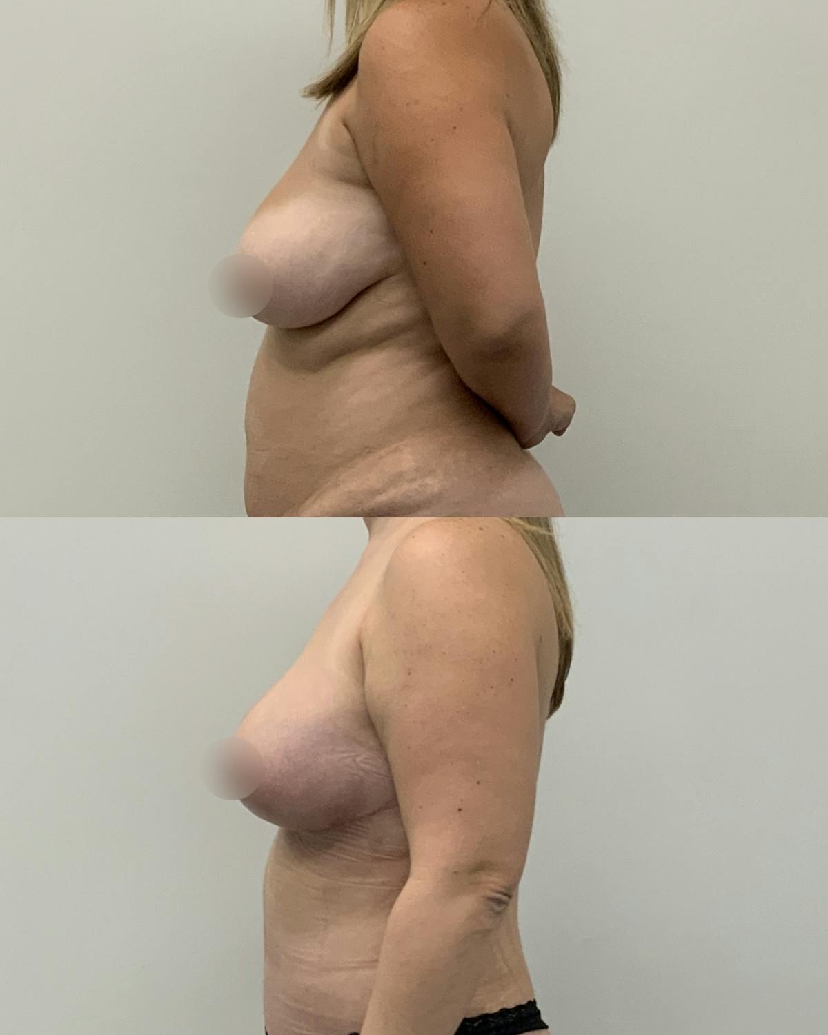 Breast Reduction Before & After Gallery - Patient 254977 - Image 3