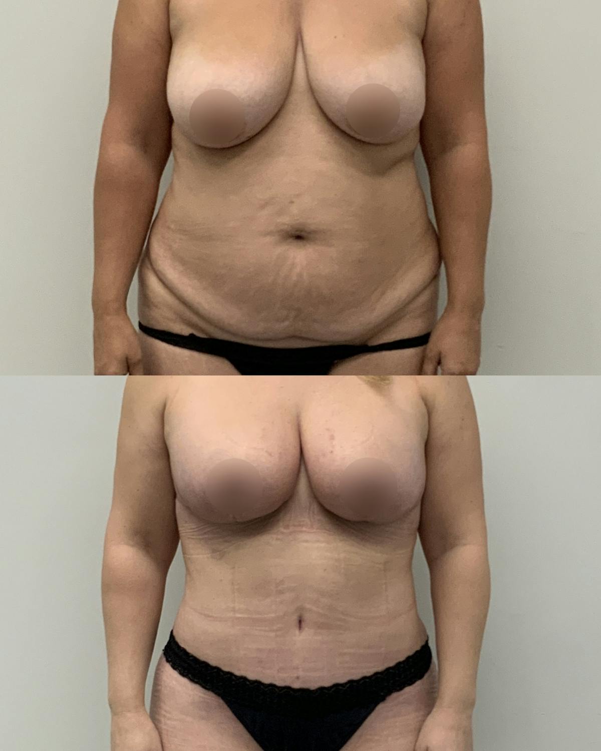 Tummy Tuck Before & After Gallery - Patient 322946 - Image 1