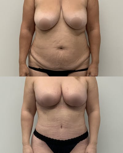 Tummy Tuck Before & After Gallery - Patient 322946 - Image 1