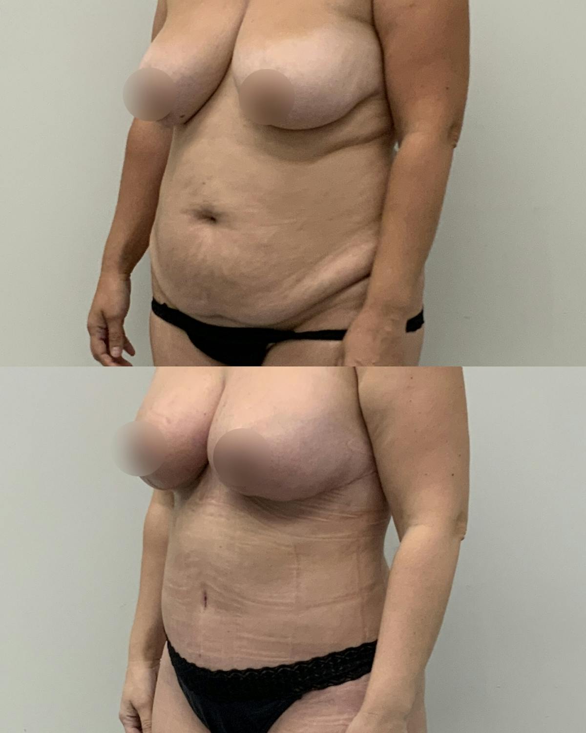 Tummy Tuck Before & After Gallery - Patient 322946 - Image 2