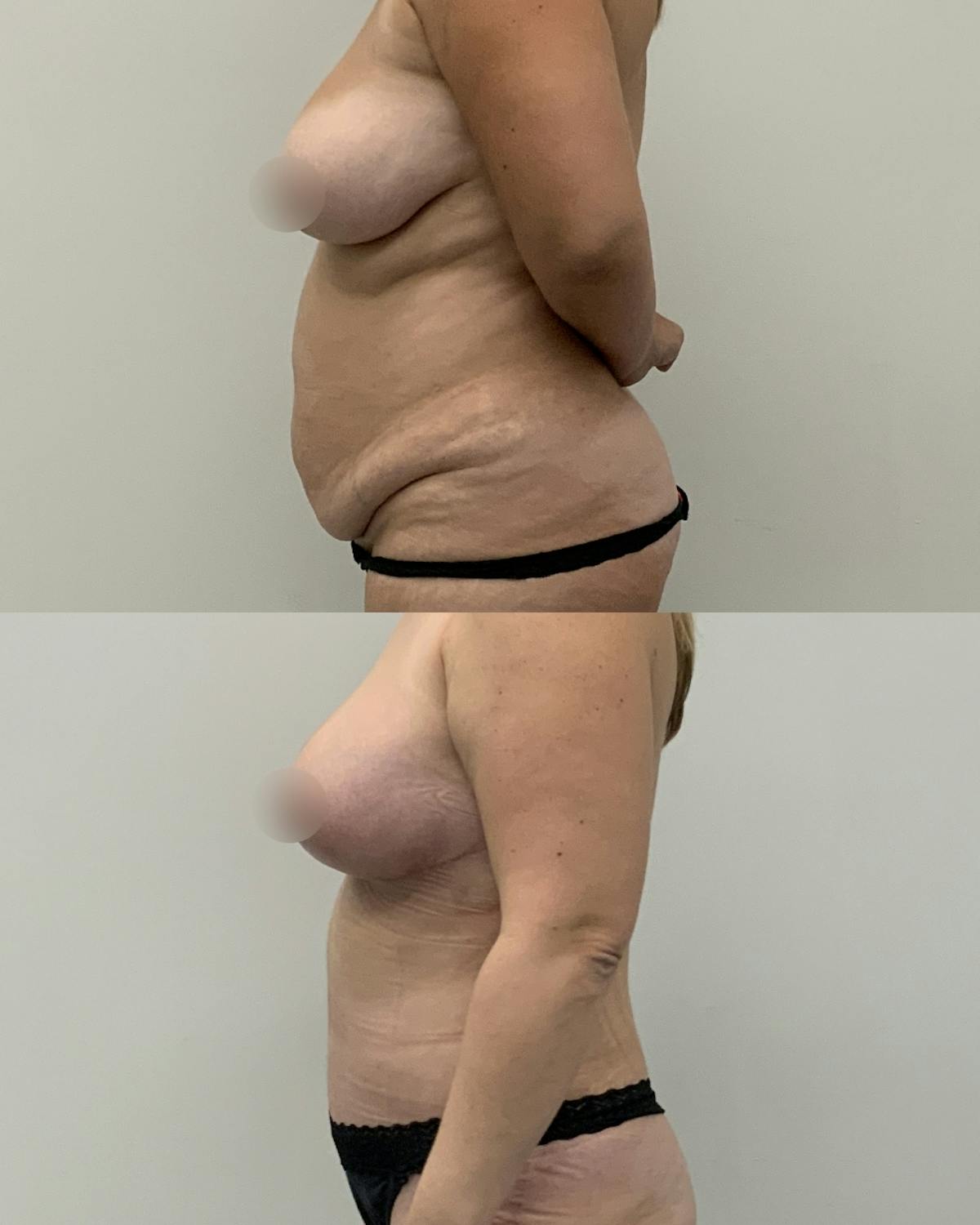 Tummy Tuck Before & After Gallery - Patient 322946 - Image 3