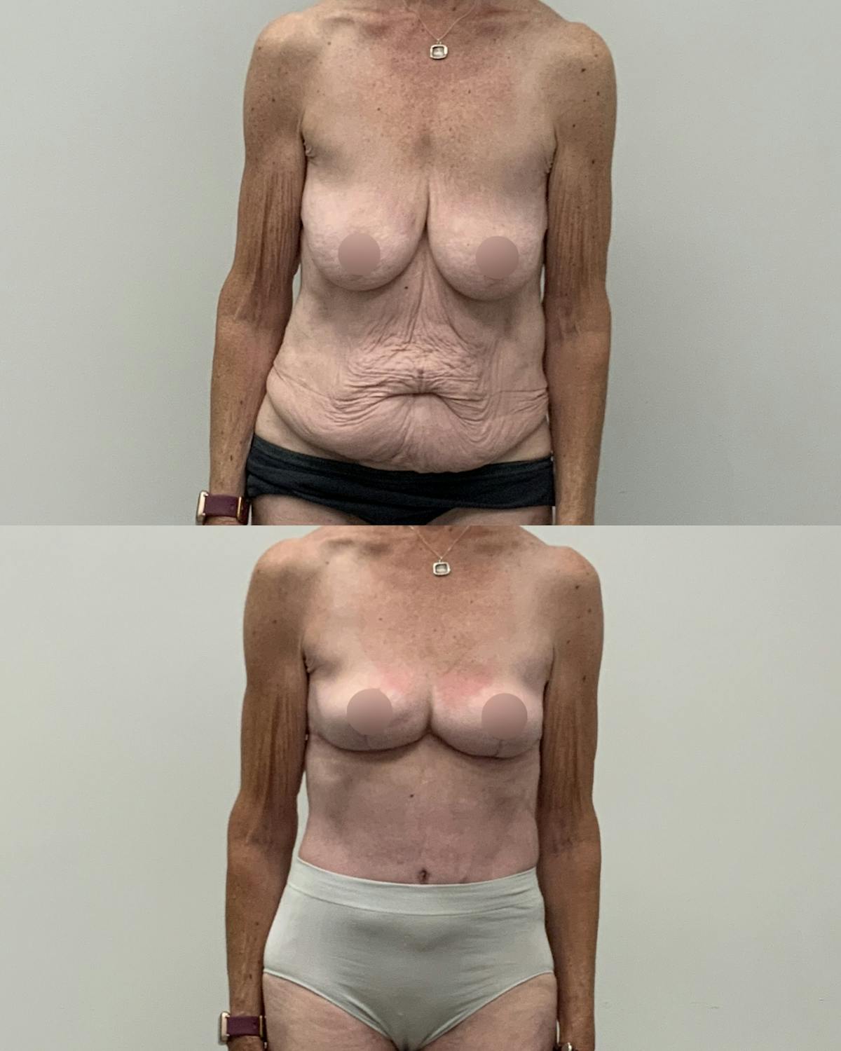 Mommy Makeover Before & After Gallery - Patient 130710 - Image 1