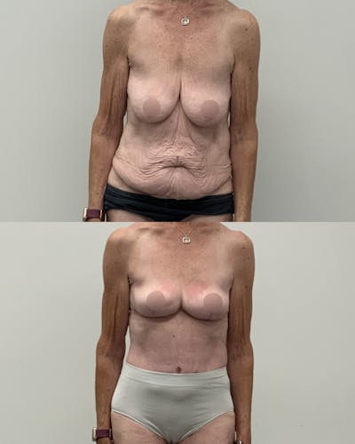 Mommy Makeover Before & After Gallery - Patient 130710 - Image 1