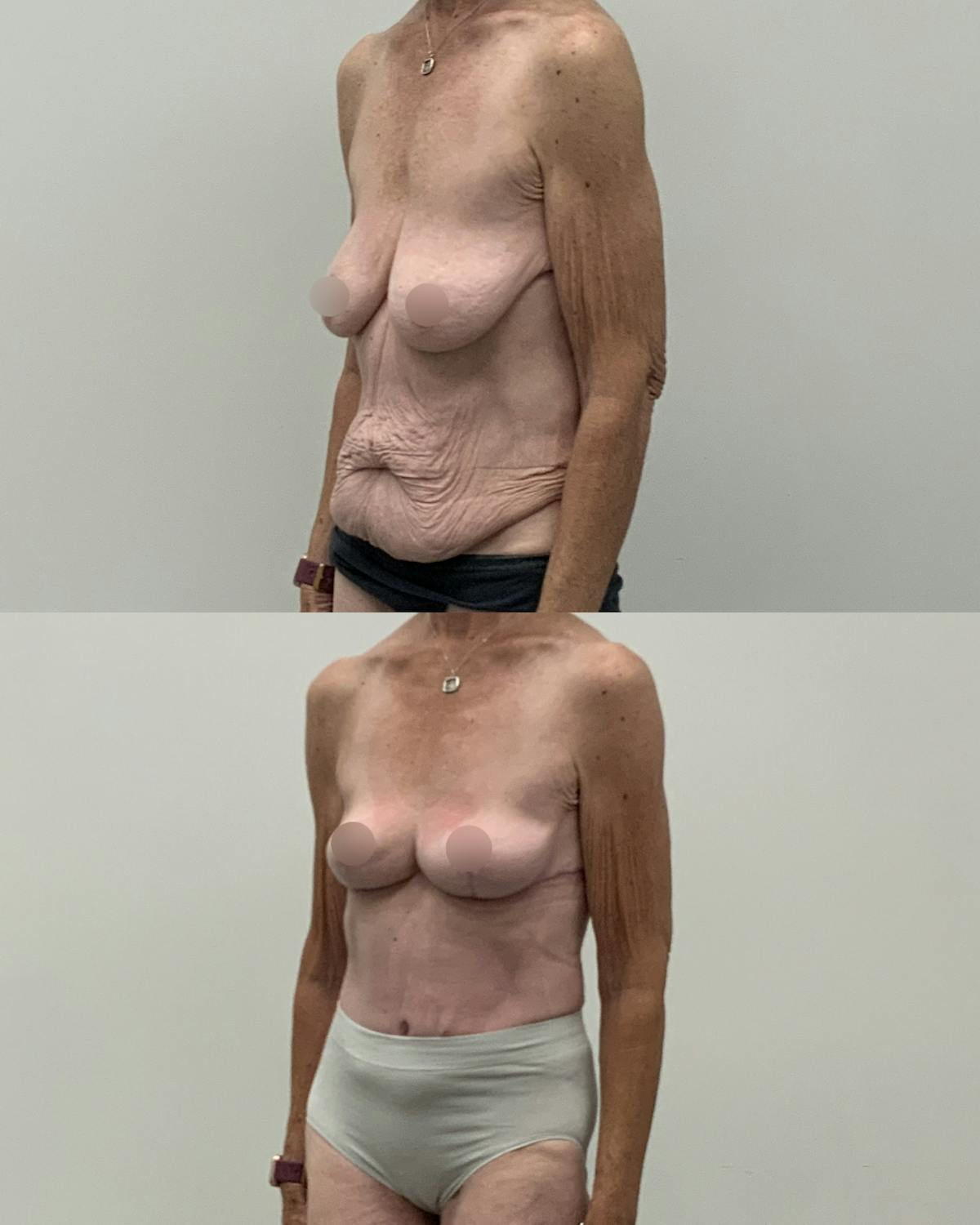 Mommy Makeover Before & After Gallery - Patient 130710 - Image 2