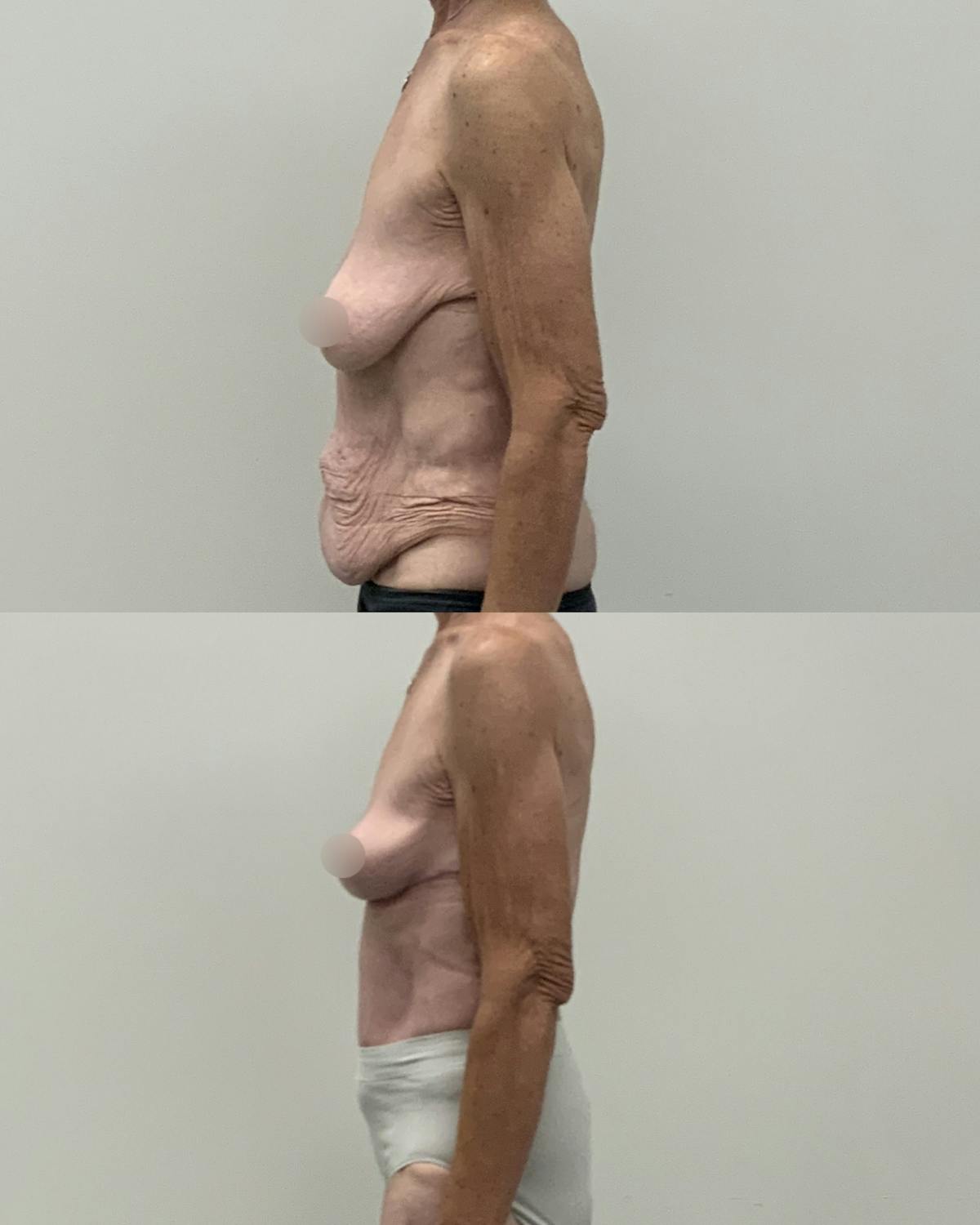 Mommy Makeover Before & After Gallery - Patient 130710 - Image 3