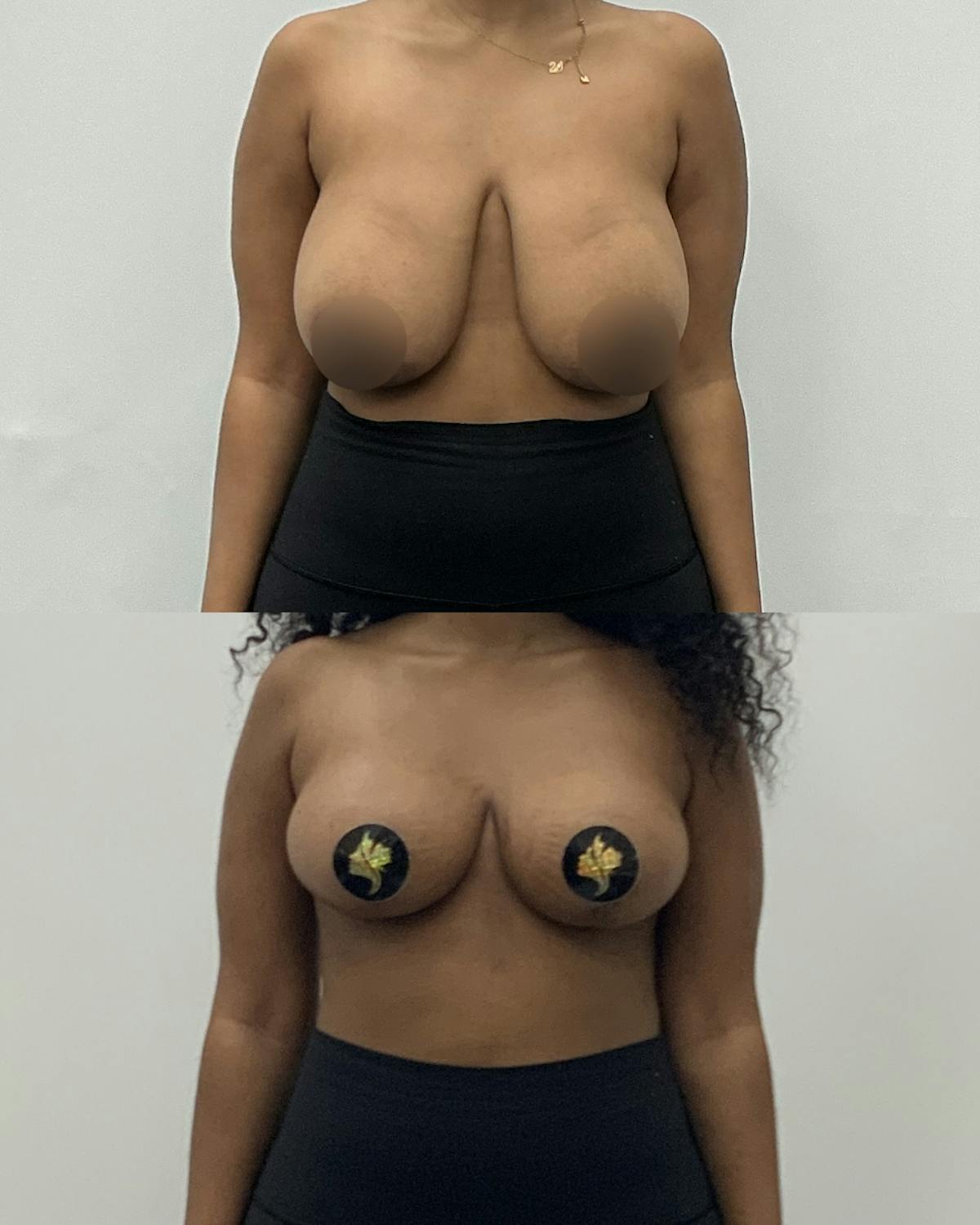 Breast Reduction Before & After Gallery - Patient 365341 - Image 1