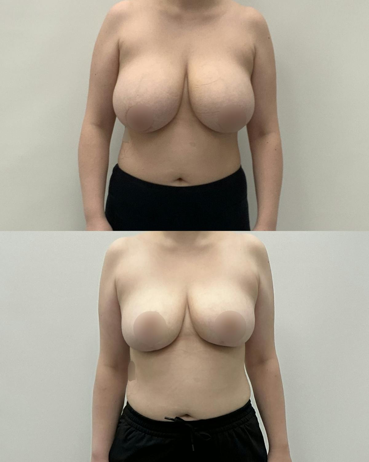 Breast Lift Before & After Gallery - Patient 362956 - Image 1