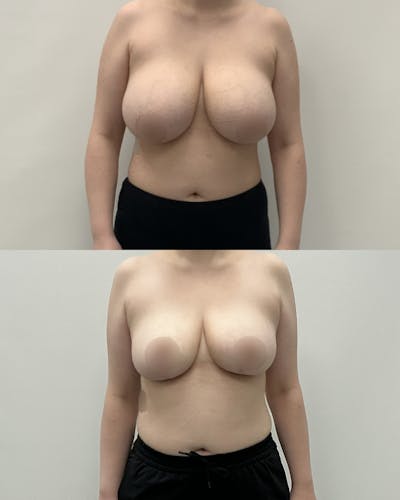 Breast Lift Before & After Gallery - Patient 362956 - Image 1