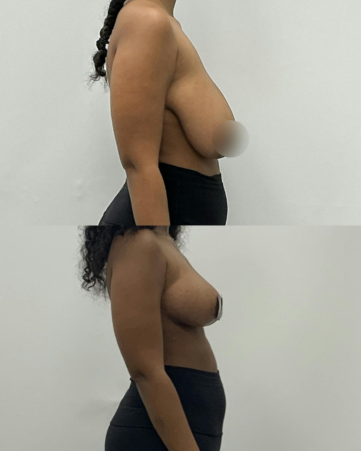 Breast Reduction Before & After Gallery - Patient 365341 - Image 3