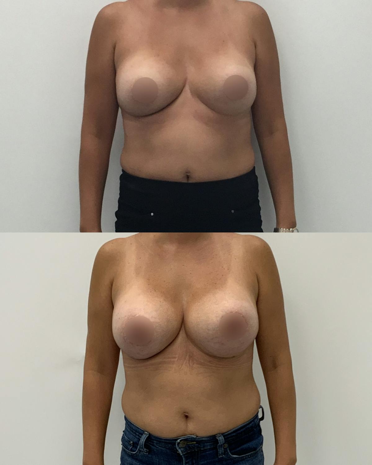 Breast Augmentation Before & After Gallery - Patient 214158 - Image 1