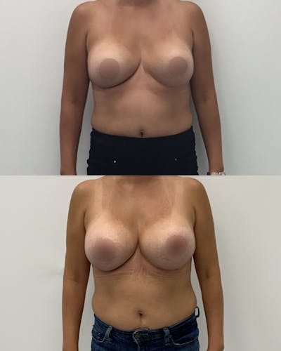 Breast Augmentation Before & After Gallery - Patient 214158 - Image 1