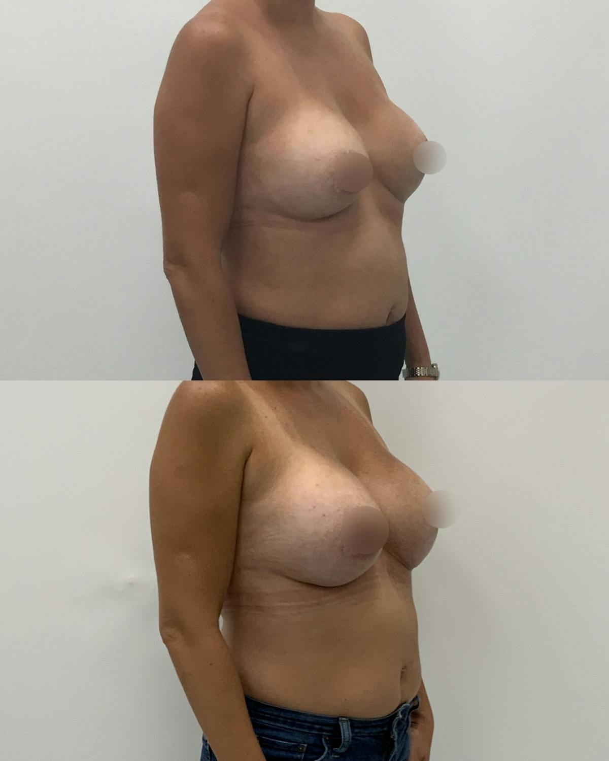 Breast Augmentation Before & After Gallery - Patient 214158 - Image 2