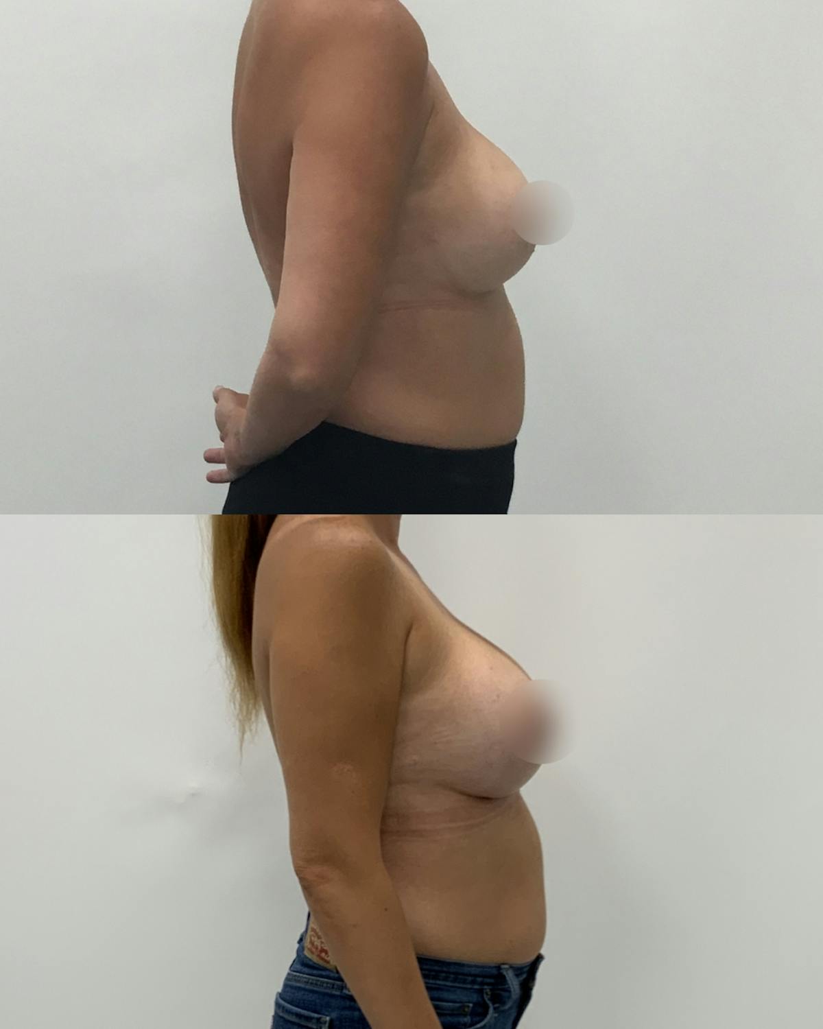 Breast Augmentation Before & After Gallery - Patient 214158 - Image 3