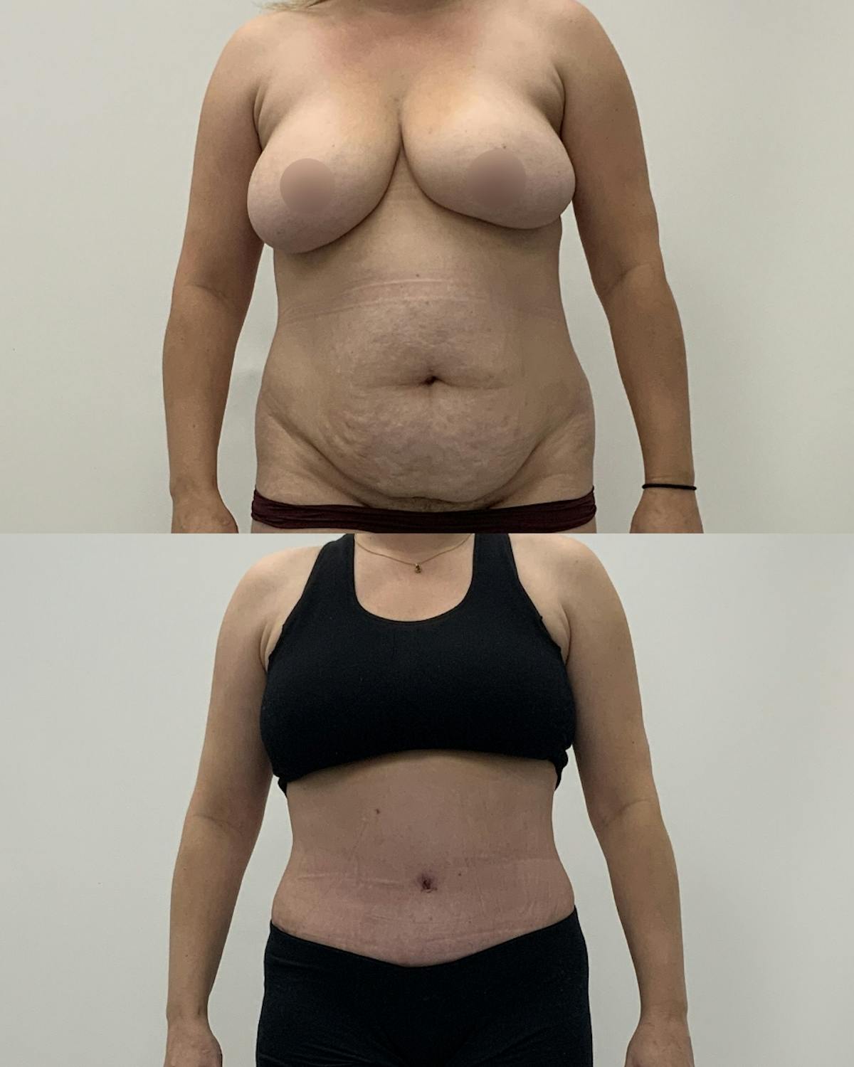 Tummy Tuck Before & After Gallery - Patient 419560 - Image 1