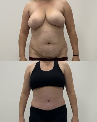 Tummy Tuck Before & After Gallery - Patient 419560 - Image 1