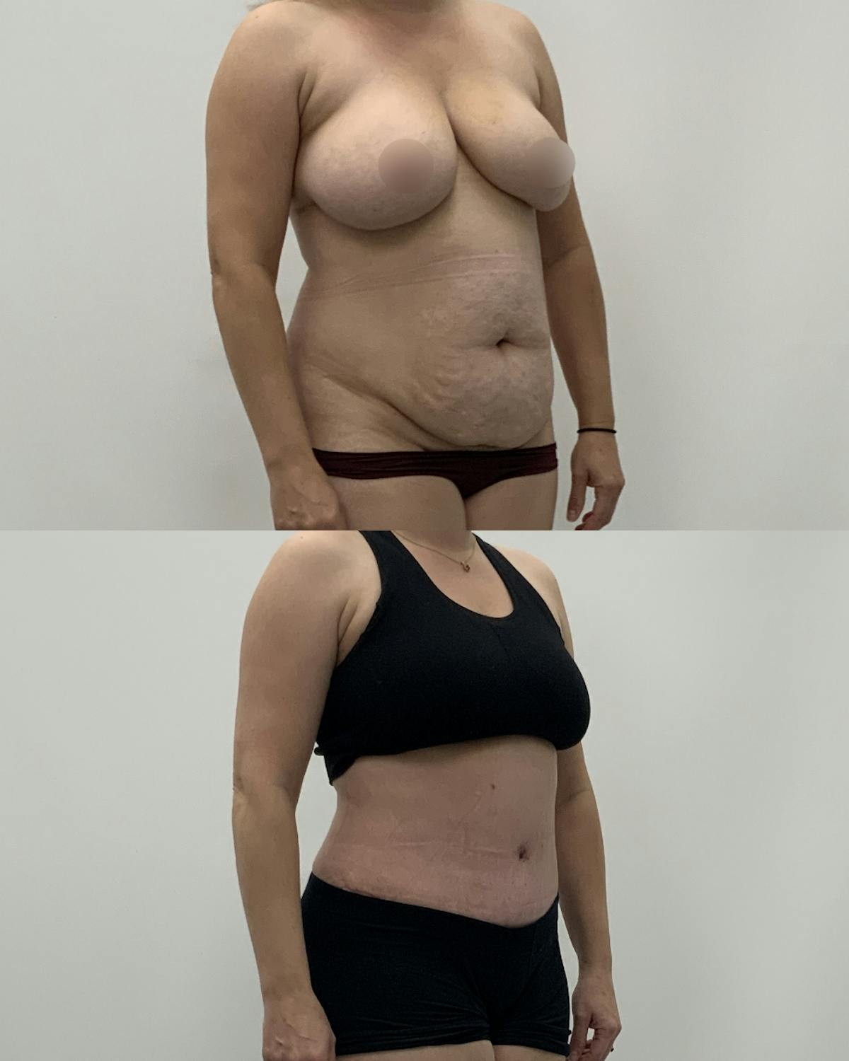Tummy Tuck Before & After Gallery - Patient 419560 - Image 2