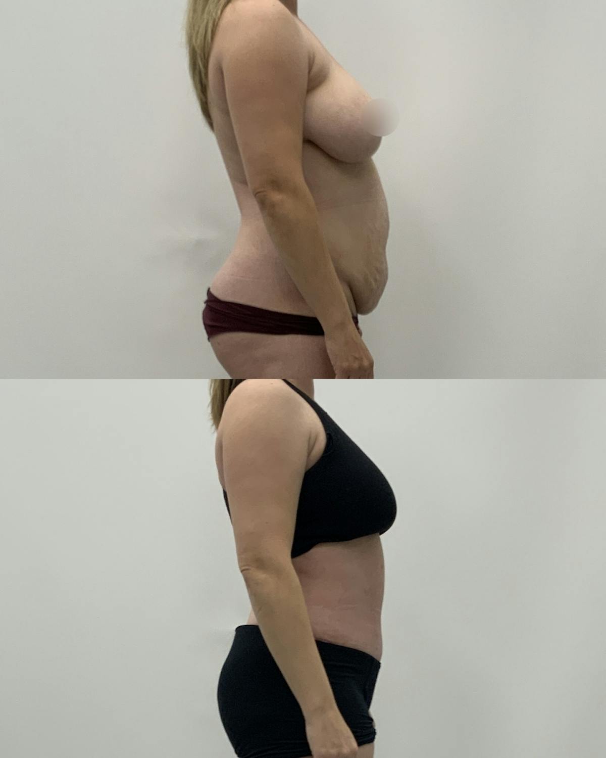 Tummy Tuck Before & After Gallery - Patient 419560 - Image 3