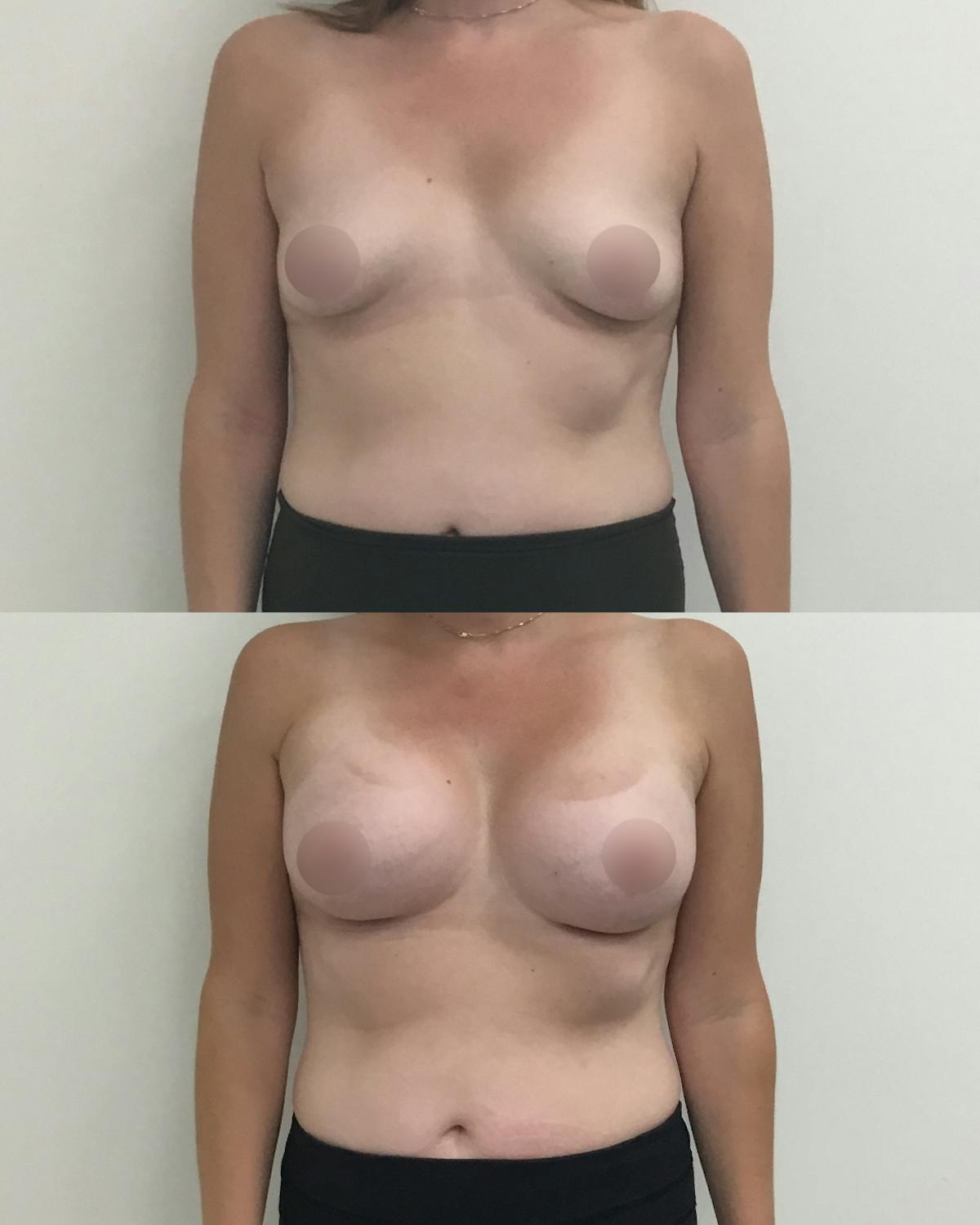 Breast Augmentation Before & After Gallery - Patient 235091 - Image 1