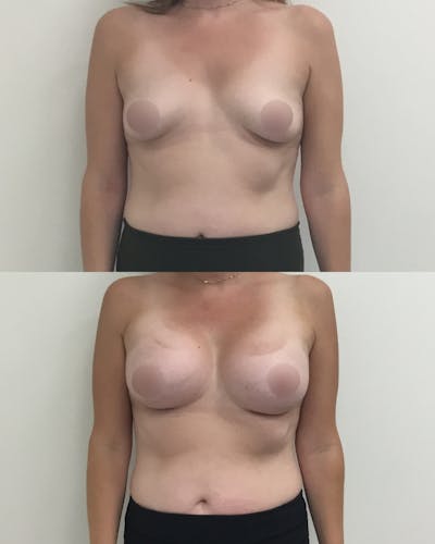 Breast Augmentation Before & After Gallery - Patient 235091 - Image 1