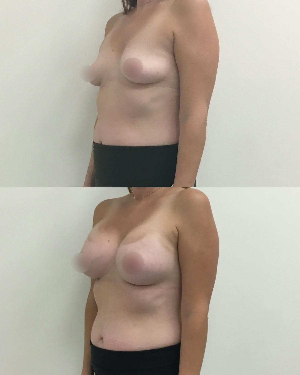 Breast Augmentation Before & After Gallery - Patient 235091 - Image 2