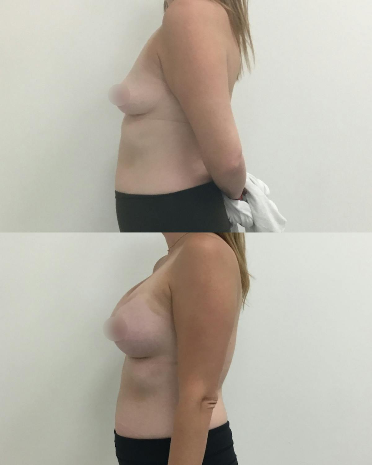 Breast Augmentation Before & After Gallery - Patient 235091 - Image 3