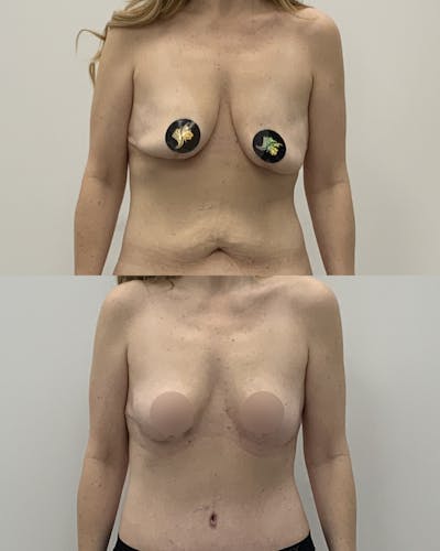 Breast Lift Before & After Gallery - Patient 136610 - Image 1