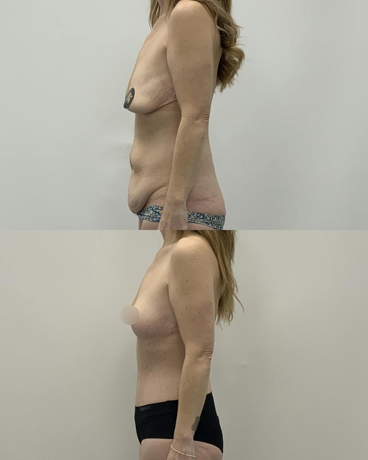 Mommy Makeover Before & After Gallery - Patient 338011 - Image 3