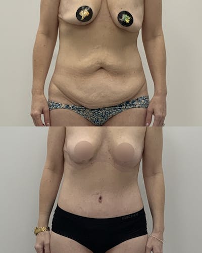 Tummy Tuck Before & After Gallery - Patient 310144 - Image 1