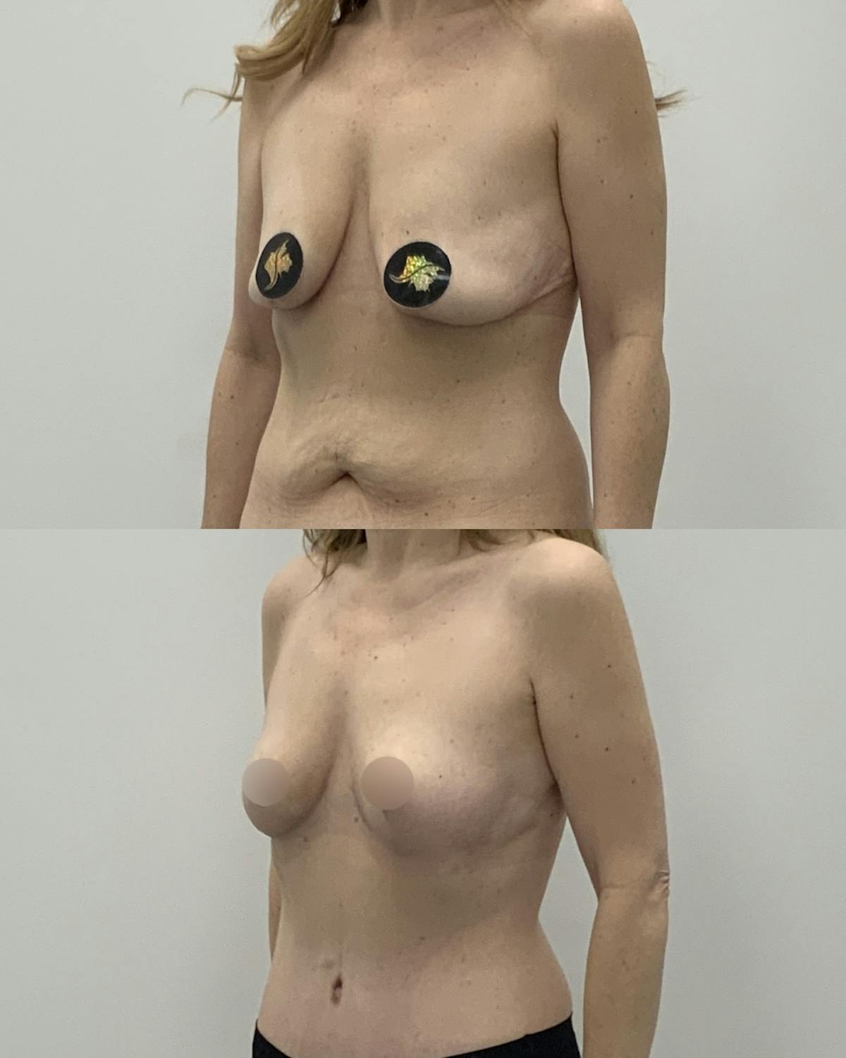 Breast Asymmetry Correction Before & After Gallery - Patient 218707 - Image 2