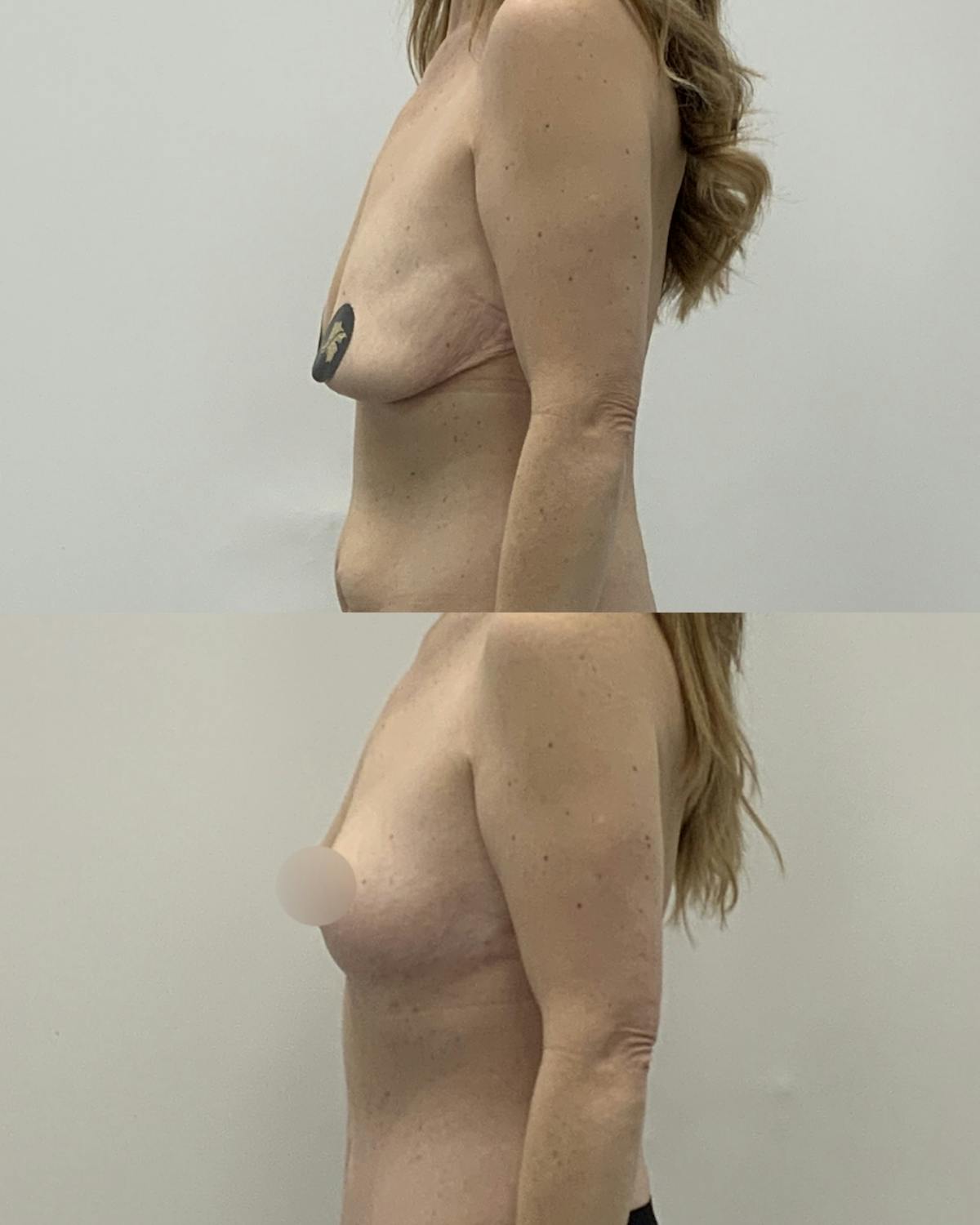 Breast Asymmetry Correction Before & After Gallery - Patient 218707 - Image 3