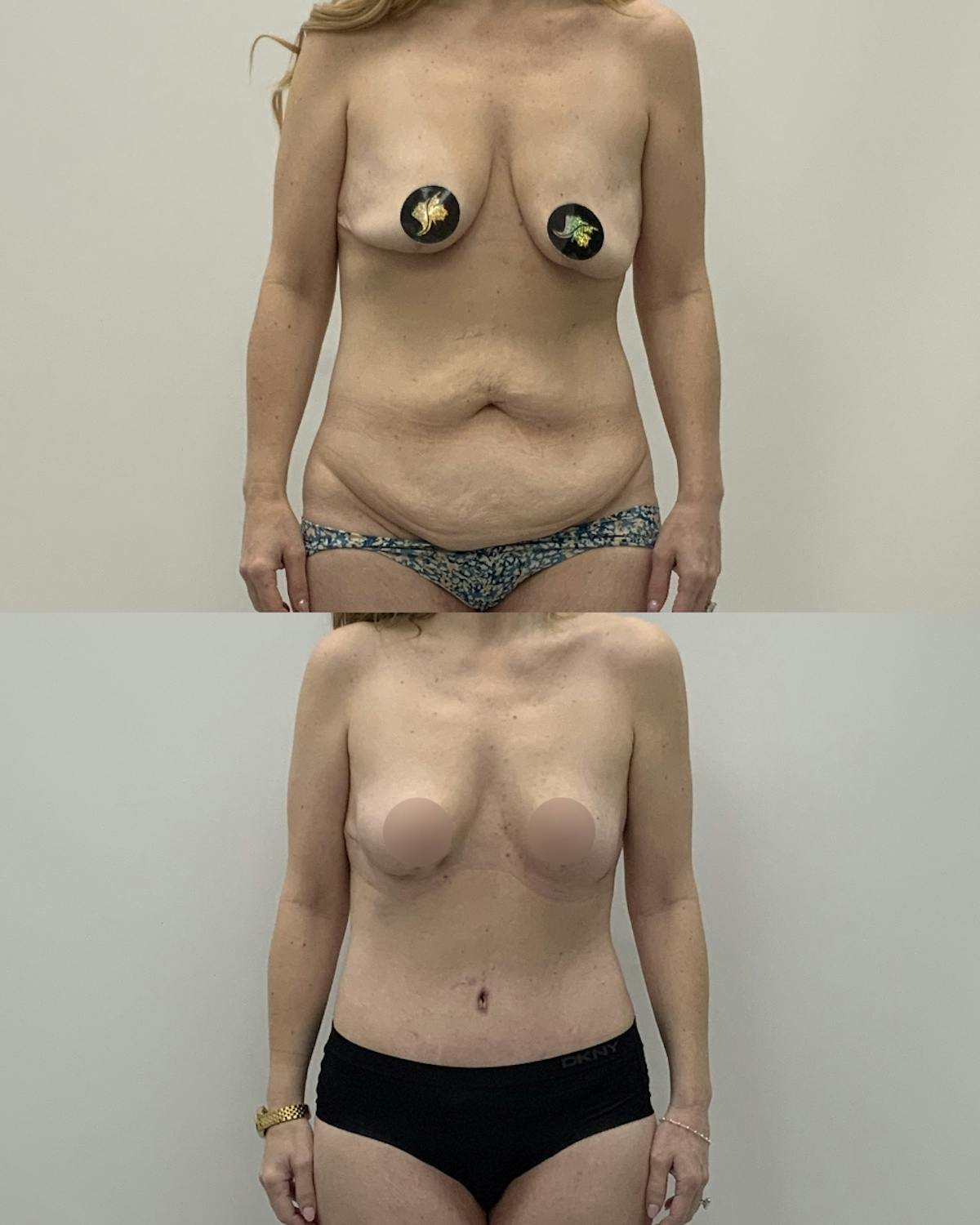 Mommy Makeover Before & After Gallery - Patient 338011 - Image 1