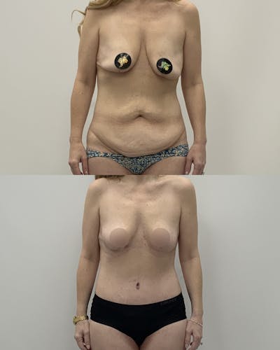 Mommy Makeover Before & After Gallery - Patient 338011 - Image 1