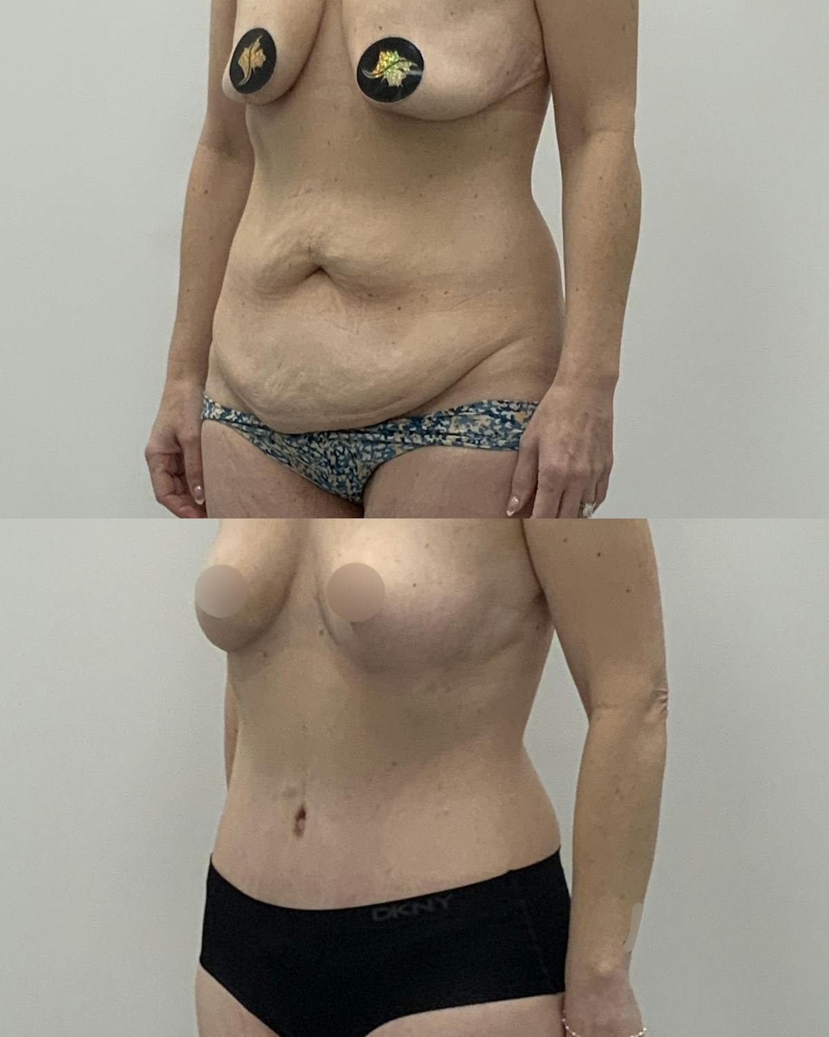 Tummy Tuck Before & After Gallery - Patient 310144 - Image 2
