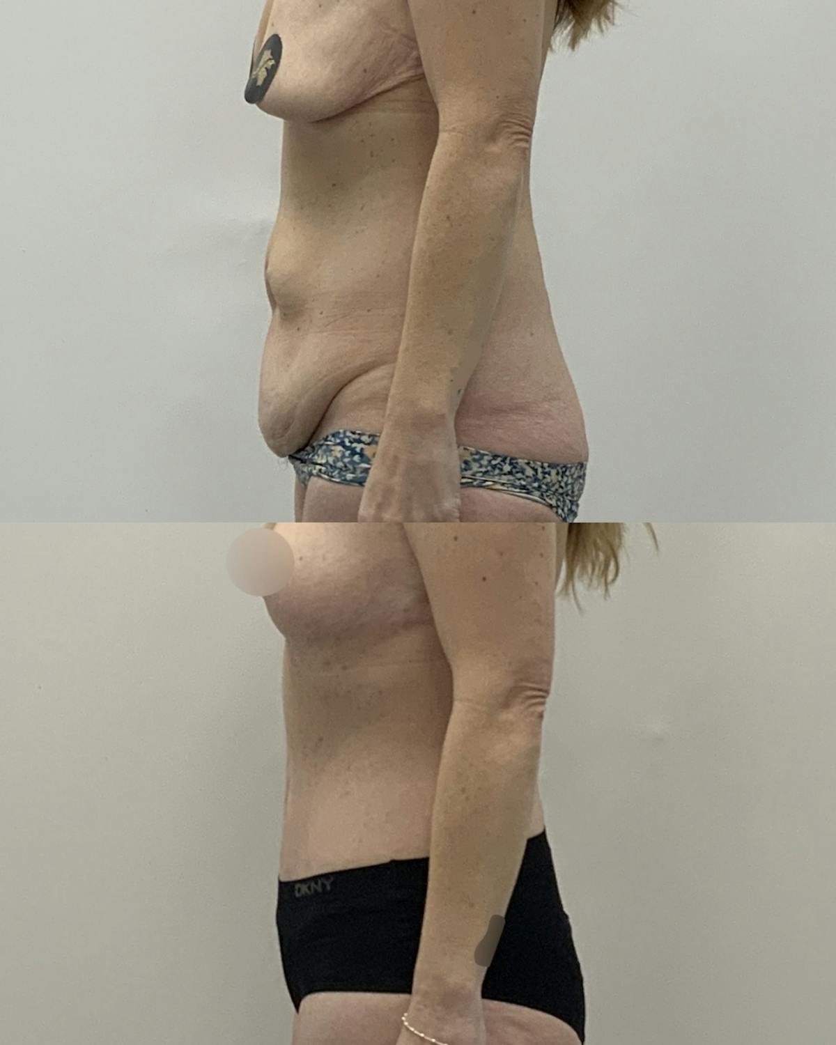 Tummy Tuck Before & After Gallery - Patient 310144 - Image 3