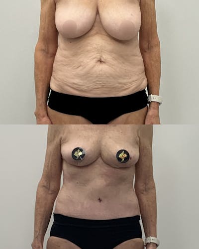 Tummy Tuck Before & After Gallery - Patient 543276 - Image 1