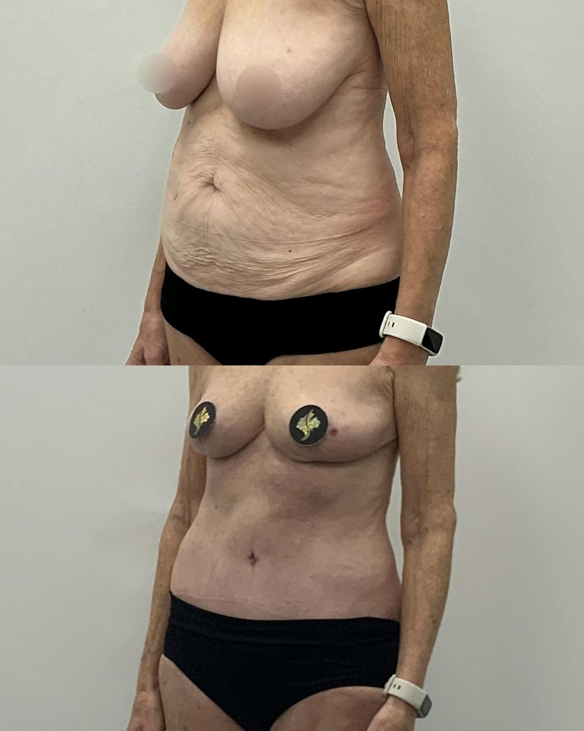 Tummy Tuck Before & After Gallery - Patient 543276 - Image 2