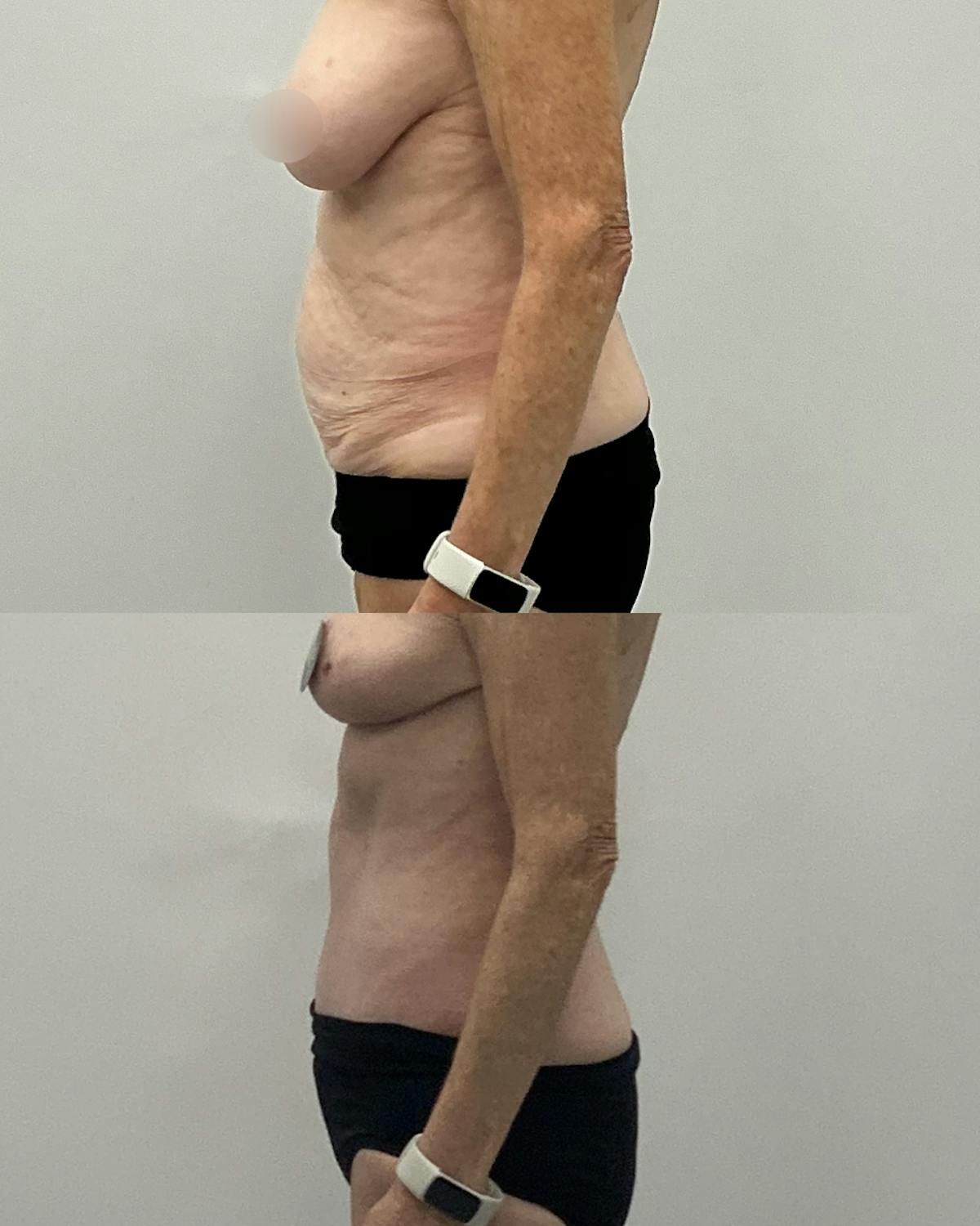 Tummy Tuck Before & After Gallery - Patient 543276 - Image 3